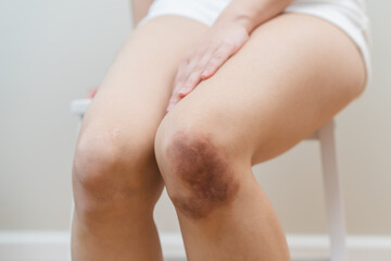 Close up of stain bruise wound on arm, contusion asian young woman, girl an accident fell down stairs, hand on knee in healing injury by massage hematoma blood