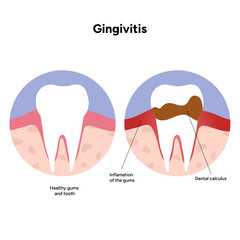 Hand-drawn dental illustration teeth affected by gingivitis. Educational medical infographic gum inflammation, redness, and early stages of periodontal disease