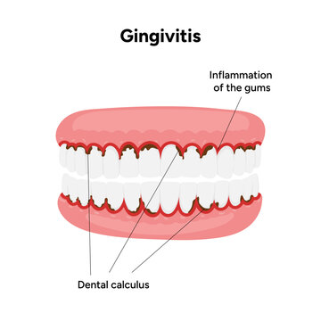 Hand-drawn dental illustration teeth affected by gingivitis. Educational medical infographic gum inflammation, redness, and early stages of periodontal disease