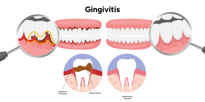 Hand-drawn dental illustration teeth affected by gingivitis. Educational medical infographic gum inflammation, redness, and early stages of periodontal disease