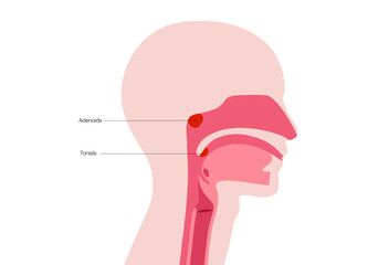 Adenotonsillar disease poster