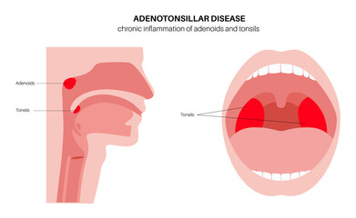 Adenotonsillar disease poster