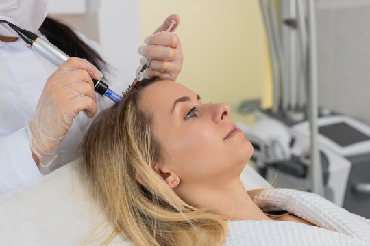 Alopecia. Woman hair loss treatment regeneration. Trichologist cosmetologist doctor applies vitamin serum injections from a syringe on head scalp dermapen fractional microneedle, clinic mesotherapy.