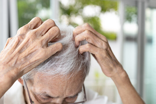 Elderly woman scratching her scalp due to itchiness or irritation,dry scalp,dandruff,fungal infection,seborrheic dermatitis,or allergic reactions to shampoo and hair care products,scalp health problem