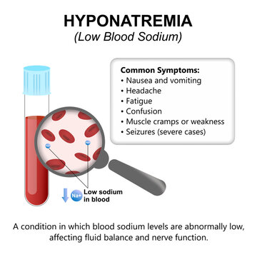 Hyponatremia (Low Blood Sodium) Medical Infographic Flashcard