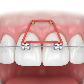 3D Dental Illustration of Orthodontic Braces with Power Chain and Mini-Implants for Diastema Correction