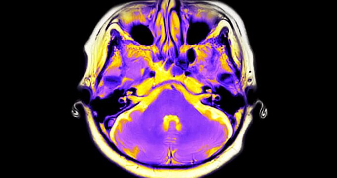 MRI brain footage showing normal anatomy with no abnormal findings. Clear visualization of brain structures highlights healthy neurological status. Ideal for medical education.
