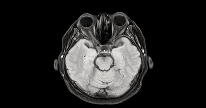 MRI brain footage showing normal anatomy with no abnormal findings. Clear visualization of brain structures highlights healthy neurological status. Ideal for medical education.