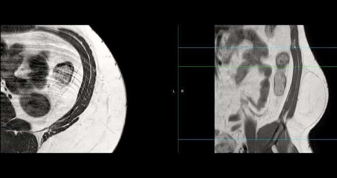 MRI whole abdomen video showing a fatty mass on the left side of the abdomen. Findings suggest a probable atypical lipomatous tumor, with differential diagnosis of well-differentiated liposarcoma. 