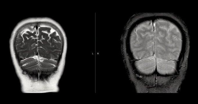 MRI brain footage showing normal anatomy with no abnormal findings. Clear visualization of brain structures highlights healthy neurological status. Ideal for medical education.