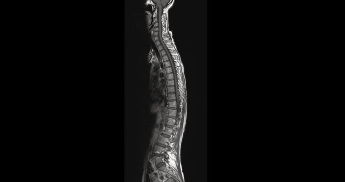 MRI screening of the whole spine in sagittal view for evaluating spinal cord stenosis. Clear visualization of vertebrae, discs, and spinal canal supports accurate diagnosis. 