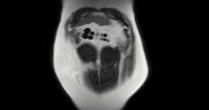 MRI whole abdomen video showing a fatty mass on the left side of the abdomen. Findings suggest a probable atypical lipomatous tumor, with differential diagnosis of well-differentiated liposarcoma. 