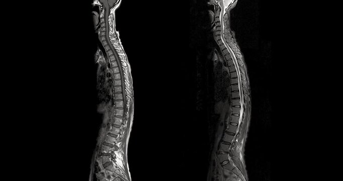 MRI screening of the whole spine in sagittal view for evaluating spinal cord stenosis. Clear visualization of vertebrae, discs, and spinal canal supports accurate diagnosis. 