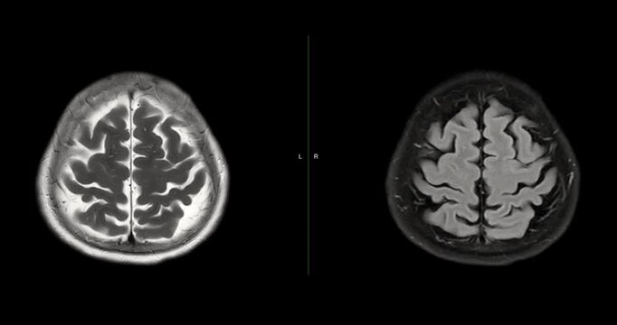 MRI brain footage showing normal anatomy with no abnormal findings. Clear visualization of brain structures highlights healthy neurological status. Ideal for medical education.