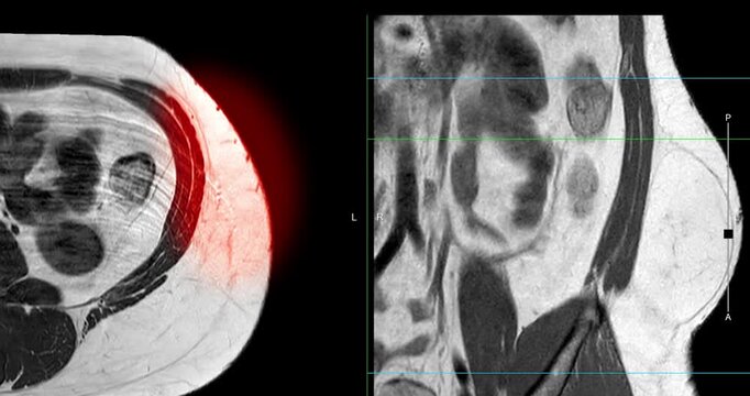 MRI whole abdomen video showing a fatty mass on the left side of the abdomen. Findings suggest a probable atypical lipomatous tumor, with differential diagnosis of well-differentiated liposarcoma. 