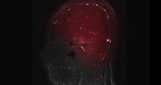 MR cerebral venography (MRV) or MRV Brain for diagnostic Cerebral venous thrombosis (blood clots in the brain) and 
Structural vein abnormalities.