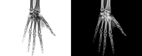 Hand Anterior View X-Ray Radiograph Showing Detailed Bone Alignment and Phalange Structure for Accurate Diagnosis of Hand Fractures Isolated on Transparent Background