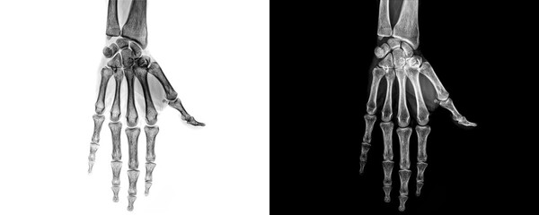 Hand Anterior View X-Ray Radiograph Depicting Clear Bone Structure and Joint Alignment for Assessment of Fractures and Traumatic Injuries Isolated on Transparent Background