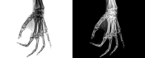 Hand Lateral View X-Ray Radiograph Showing Detailed Bone Contours and Joint Alignment for Accurate Diagnosis of Hand Fractures Isolated on Transparent Background