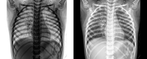 Chest Anterior Projection X-Ray Image Displaying Pulmonary and Cardiac Anatomy for Evaluation of Chest Pain and Related Conditions Isolated on Transparent Background