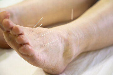 Patient receiving acupuncture treatment on foot for pain relief, thin needles stimulating pressure points on skin to promote healing and wellness, close-up view