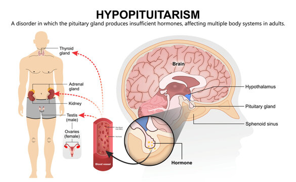 Hypopituitarism in Adult Medical Infographic Flashcard