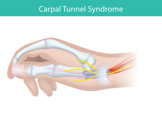 Carpal Tunnel Syndrome Nerve Compression