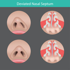 Comparison of Normal vs Deviated Nasal Septum
