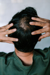 Fototapeta premium Man Examining Scalp for Signs of Hair Loss