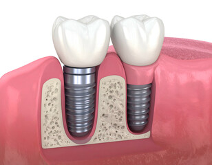 Obraz premium Dental implant and crown placement in jawbone