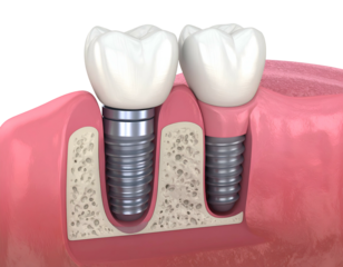Dental implant and crown placement in jawbone