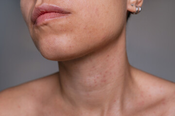Close up of young woman's chin and neck with small pimples and uneven skin texture. Natural skin imperfections, skincare and dermatology concept, sensitive skin, beauty realism, cosmetic care