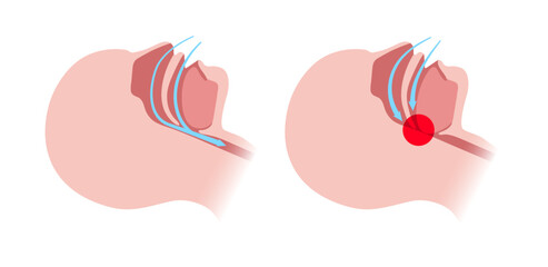Obstructive sleep apnea