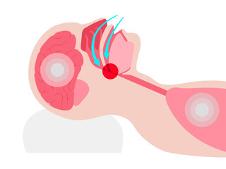 Obstructive sleep apnea