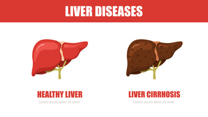 Liver disease. Healthy and cirrhosis liver. Internal organ icons. Medical illustration. Vector design.