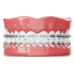 Dental Model with Braces on Teeth