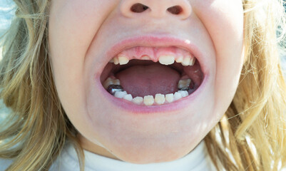Child with tooth gap. Dental kid closeup mouth. New teeth growing. Toothless kids dental smile. Child losing teeth. Dental growth. Teeth baby care. Closeup child mouth. Dental treatment, child caries.