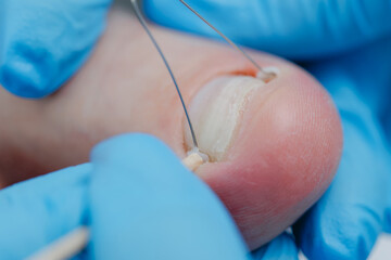 Close-up of medical procedure treating ingrown toenail on foot with bracket