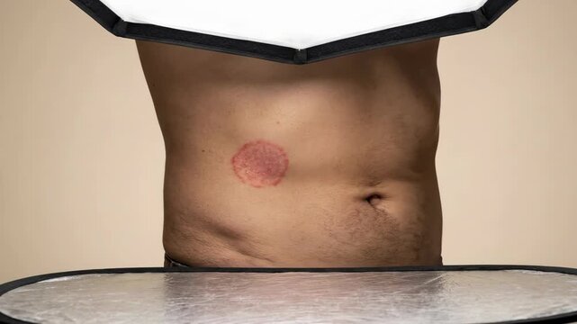 Close-up of a persons torso showing a red circular rash on the skin.