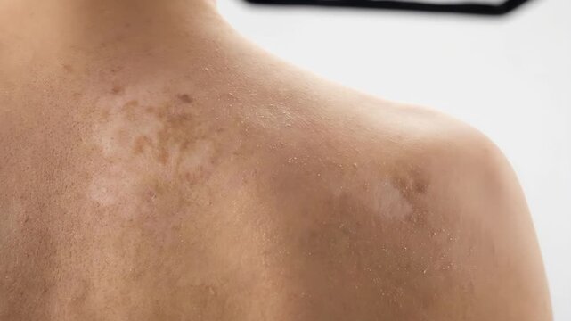 Close-up of a persons back showing skin texture and minor imperfections.