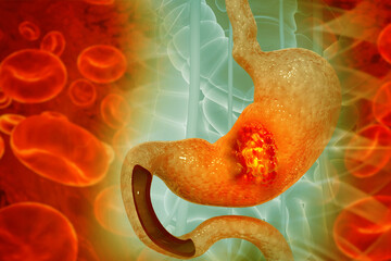 Cancer cells attacking the stomach, gastric cancer, symptoms, stages, treatment, 3d illustration