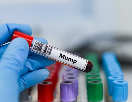 Blood sample tube for mump test analysis.