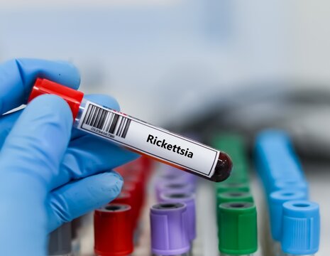 Blood sample tube for rickettsia test analysis.