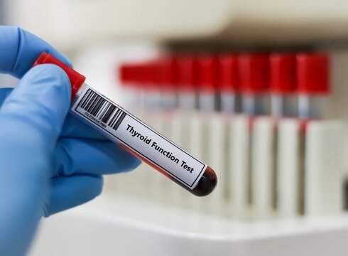 Blood sample tube for thyroid function test analysis.