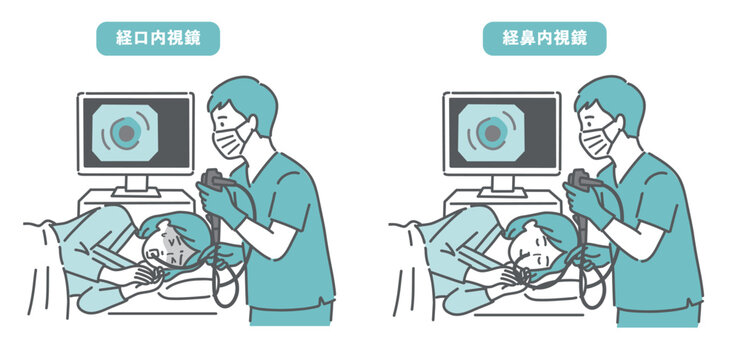経口内視鏡と経鼻内視鏡の比較イラスト（苦痛と安楽の違い）