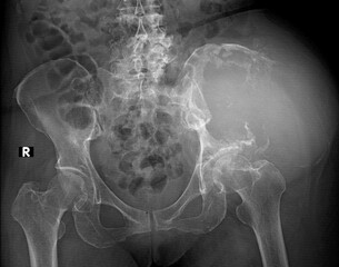 X-ray of the pelvis of a patient with aggressive primary bone tumor showing an ill-divined lytic lesion with wide zone transition, destruction of the ilium , left pelvis bone 