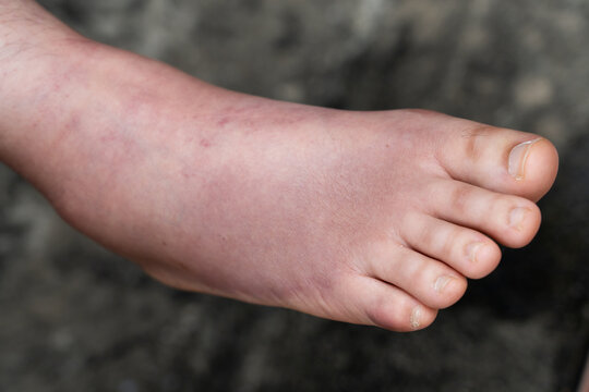 Swollen Foot After Cast Removal of Metatarsal Fracture