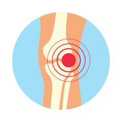 Illustration of arthritis or arthrosis of the knee joint using visual representation of pain signals and joint structure.