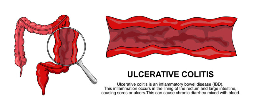 Illustration of ulcerative colitis, inflammatory bowel disease. Inflammation of the human digestive system. Vector illustration for medical, science, and educational posters.