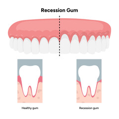 Hand-drawn dental illustration comparing gum recession and healthy gums with detailed anatomy. Educational infographic differences in tooth and gum structure